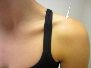 Location of pain with distal clavicle osteolysis