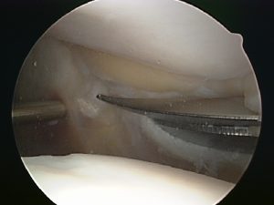 Lateral release Lateral release