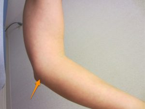Location of snapping nerve of the elbow