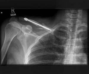 Post surgery clavicle Clavicle fracture fixation