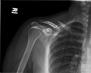 Presurgery clavicle Clavicle fracture