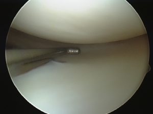 Normal Articular Cartilage
