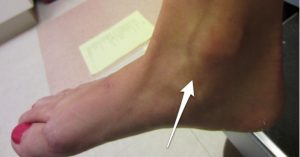 Deltoid ligament Deltoid ligament