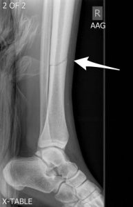 Nondisplaced tibial shaft fracture