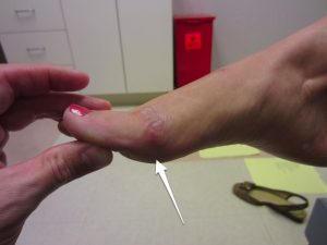 Turf toe Turf toe