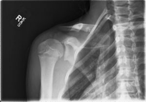 Little Leaguer's shoulder is a common pitchers injury
