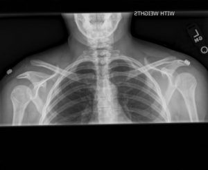 Do you need surgery for a shoulder separation?