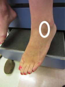 Lateral impingement Location of lateral ankle impingement pain