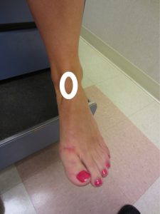 Medial ankle impingement Location of medial ankle impingement