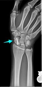 X-ray of a scaphoid fracture after surgery