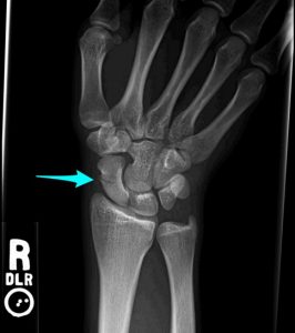 Scaphoid fracture before surgery