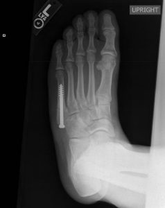 Jones fracture postoperative x-ray