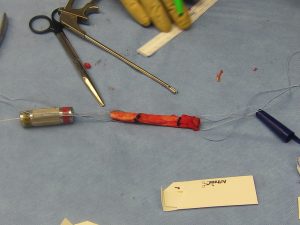 Patellar tendon graft for ACL reconstruction