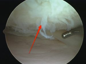 Cartilage damage in the knee