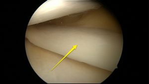 Normal meniscus