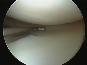 Normal articular cartilage without cartilage damage