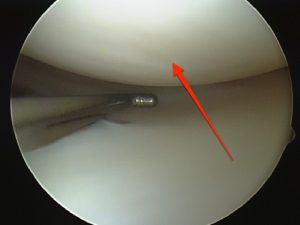 Normal articular cartilage of the knee