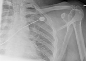 Shoulder x-ray