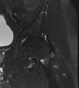 MRI of a hip labral tear