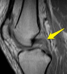 MRI showing torn PCL of the knee