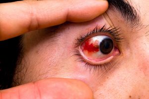 Eye injuries in sports are common.
