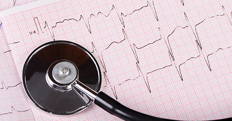 ECG or EKG to screen to prevent sudden cardiac death