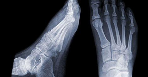 X-ray looking for stress fracture of the foot