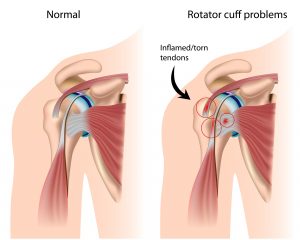 Rotator cuff illustration