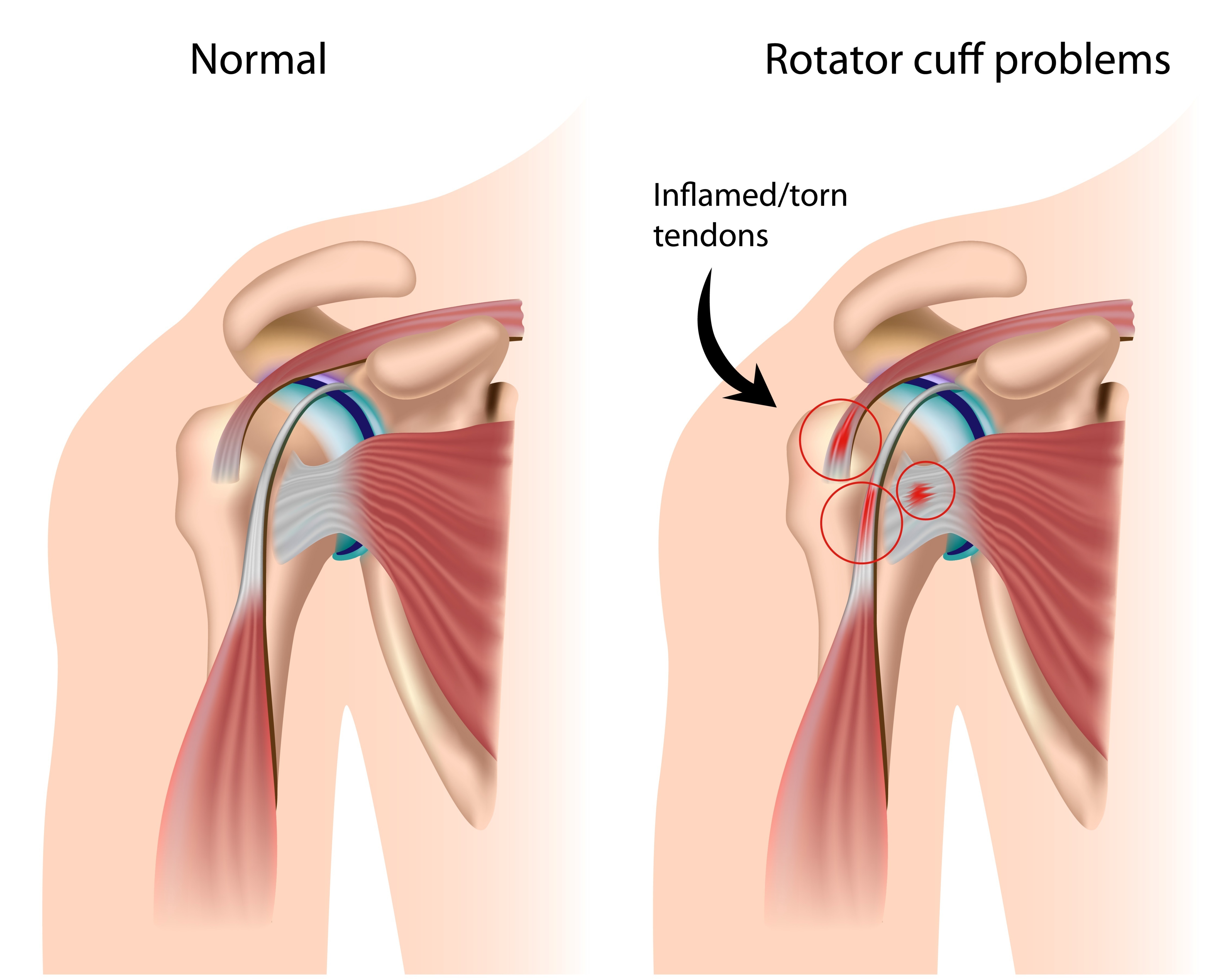 Questions Surrounding The Rotator Cuff Tear In Manny Pacquiaos Shoulder Dr David Geier
