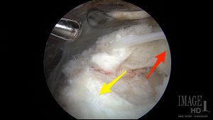 In this arthroscopic image, the rotator cuff tendon (red arrow) has pulled off its attachment site on the humerus (yellow arrow).