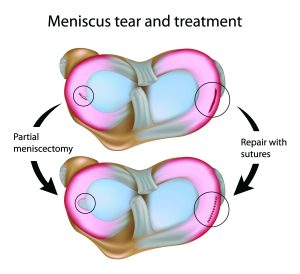 Meniscus tear treatment illustration