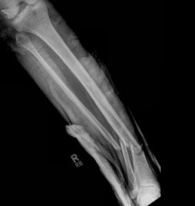 Can you play sports after a tibia fracture?