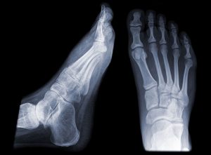 Foot x-rays