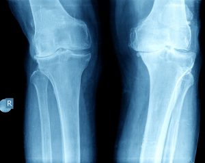 X-ray showing knee arthritis