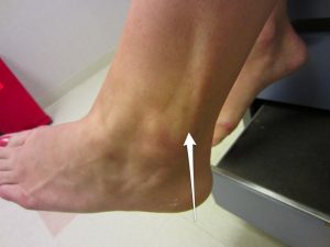 Location of the peroneal tendons, site of common ankle injuries