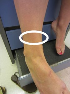 High ankle sprain, one of the common ankle injuries