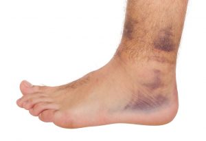 Bruised ankle