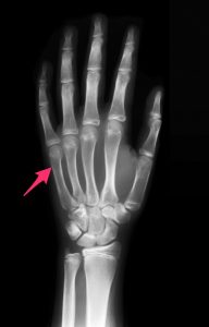 While this x-ray is negative, the arrow points to where a boxer’s fracture would be.