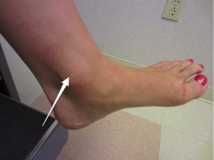 Medial malleolus, another common foot stress fracture