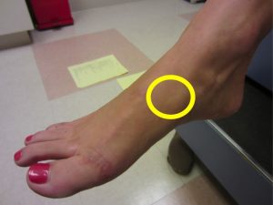 Location of the navicular, a common foot stress fracture
