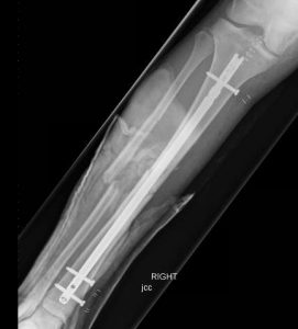 X-ray of a tibial nail used to treat a tibia fracture