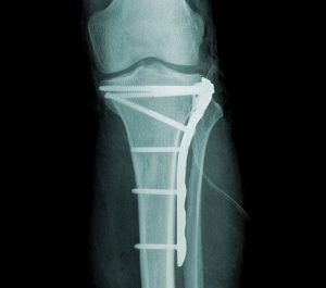 X-ray of a tibial plateau fracture fixed with plates and screws