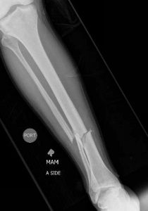 X-ray of a tibia fracture