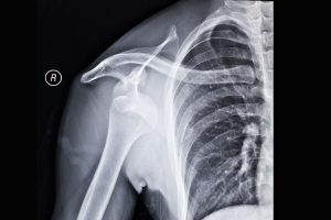 Shoulder dislocation x-ray