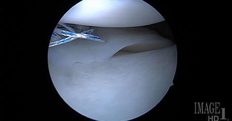 Surgeon performing a meniscus repair