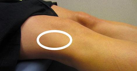 Iliotibial band (IT band) syndrome: Common cause of knee pain in