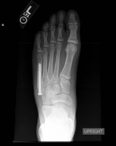 Screw placed across foot fracture