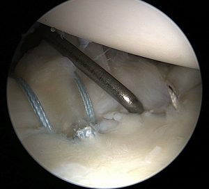 Surgical photo of repair of shoulder labral tear for shoulder instability