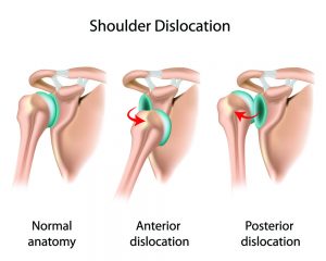 Illustration of shoulder dislocations