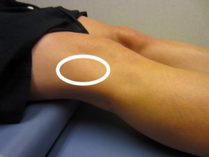 Location of knee pain with IT band syndrome